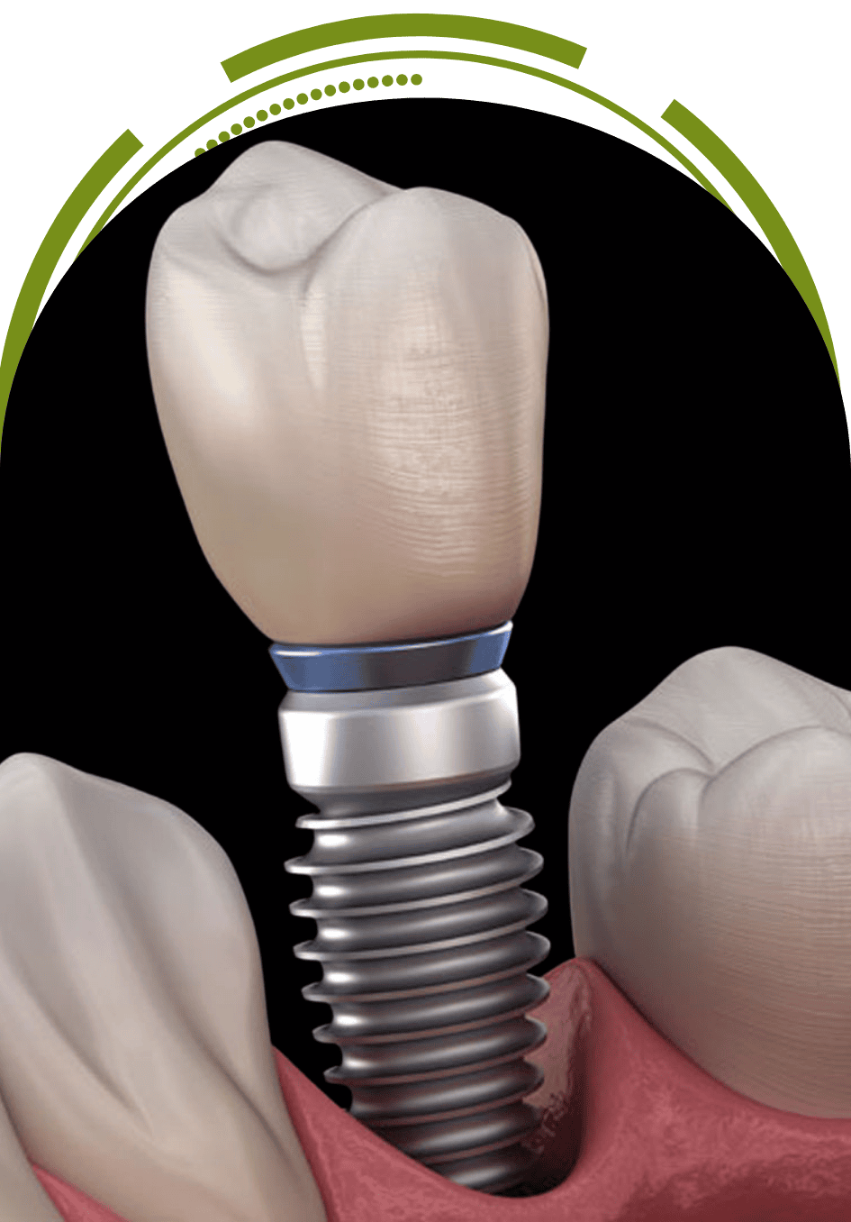 Single dental implant with crown in jawbone, permanent tooth replacement at EnamelDent Implant Tijuana